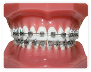 metal braces