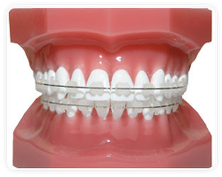 Seramik Braketler Ceramic Braces