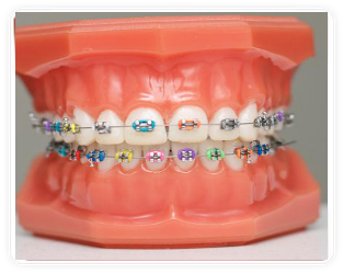 Coloured Metal Braces