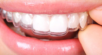  Diş Telsiz Ortodonti Tedavisi
