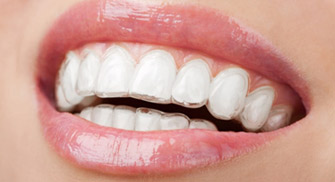 Invisalign Braces