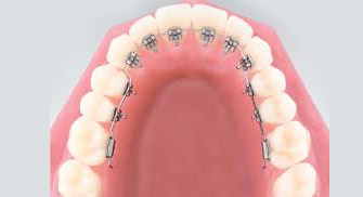 Lingual Braketler İçeri Braketler