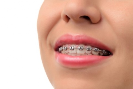 Metal Braces