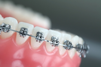 Diş Telleri Braces, Braket