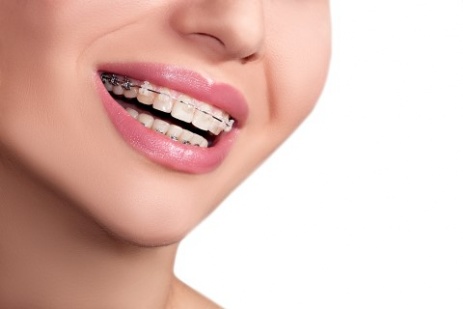 Seramik Braketler Seramic Braces for Orthodontics